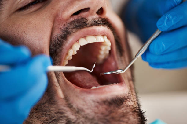 Best Knocked-Out Tooth (Avulsed Tooth) Treatment in Lexington, VA